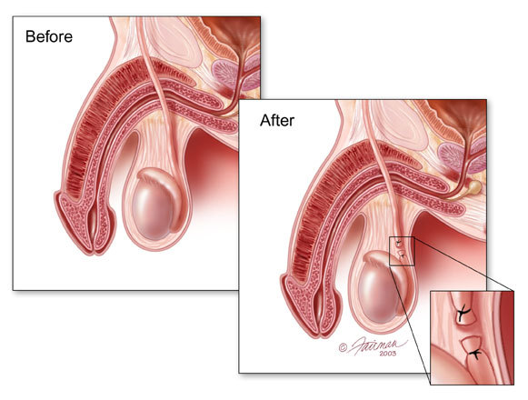 Cabinet de Gynecologie - Et les hommes? Vasectomie